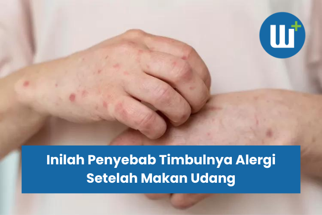 Inilah Penyebab Timbulnya Alergi Setelah Makan Udang